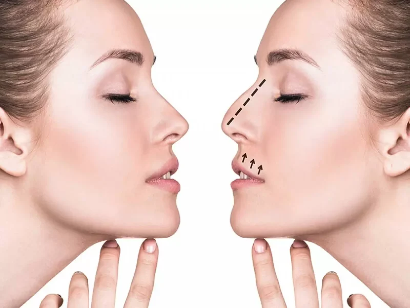 تجميل الأنف بدون جراحة في مصر والأثار الجانبية 2 ما هي عملية تجميل الأنف بدون جراحة؟