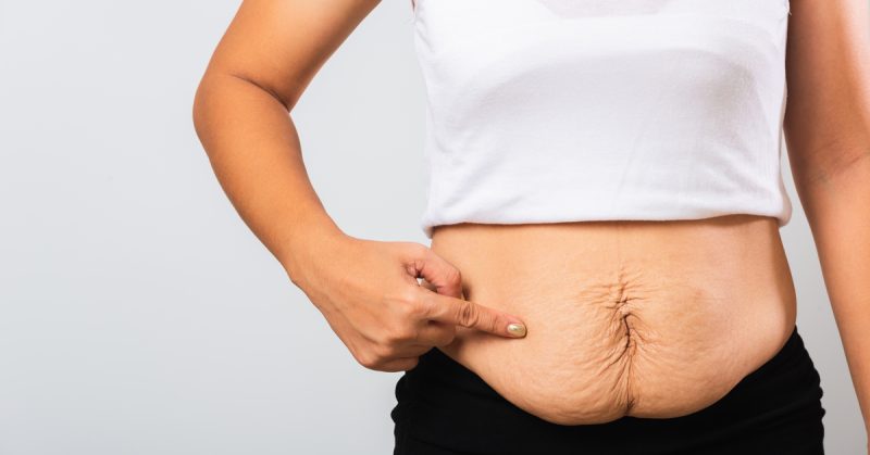 كيفية شد ترهلات البطن قبل وبعد مع د. محمد أبوليلة؟