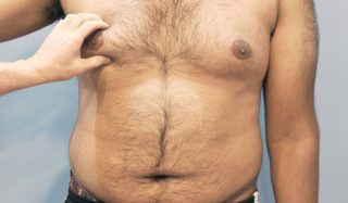 كيف يمكن علاج التثدي عند المراهقين؟