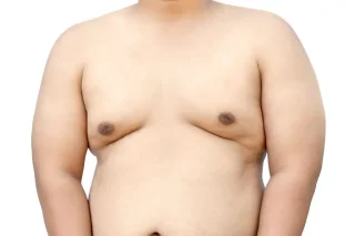 هل يذهب التثدي بدون جراحة؟