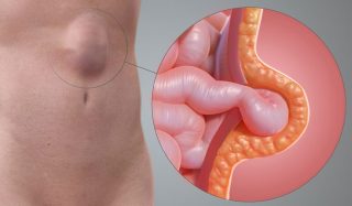 هل يمكن إجراء عملية الفتق مع شد البطن؟